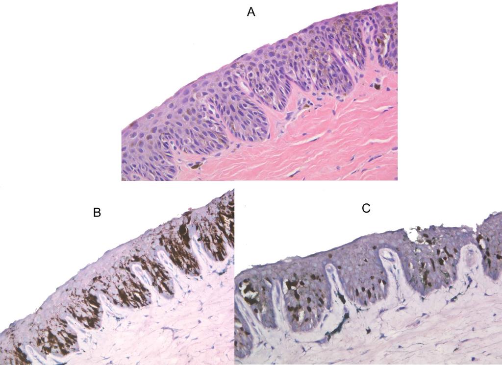 Pigmented lesions of the nail unit 151 Figure 4 Immunohistochemistry in the evaluation of nail unit melanocytic neoplasms.
