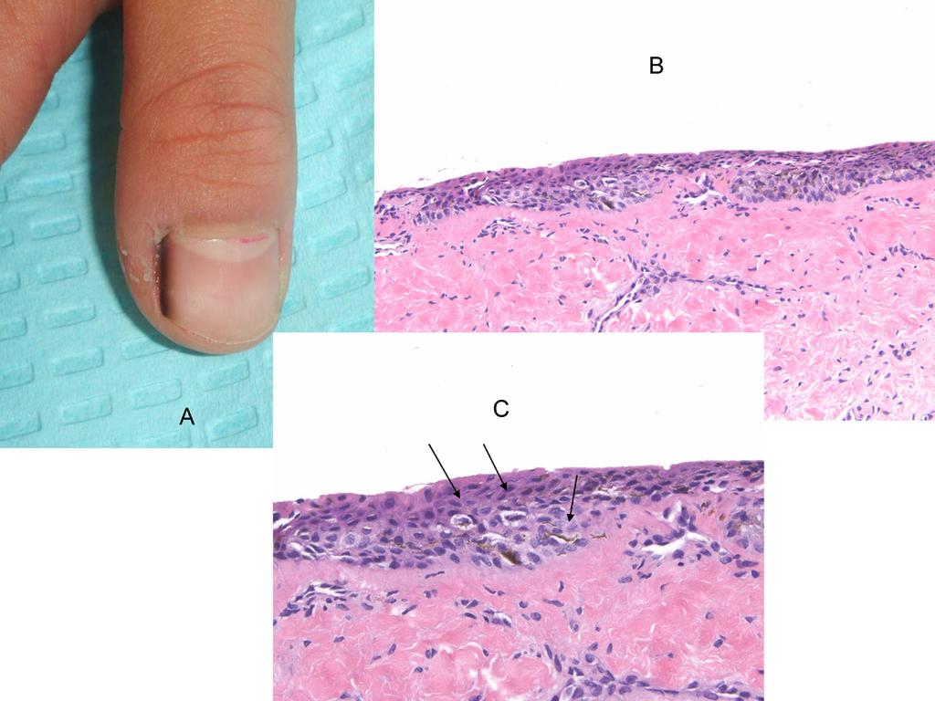 Pigmented lesions of the nail unit 153 Figure 6 Lentigo.