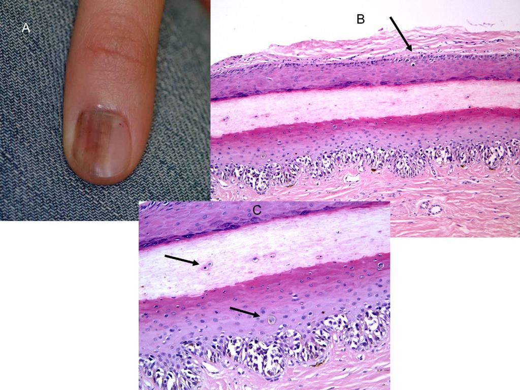 Pigmented lesions of the nail unit 155 Figure 8 Melanoma in situ.