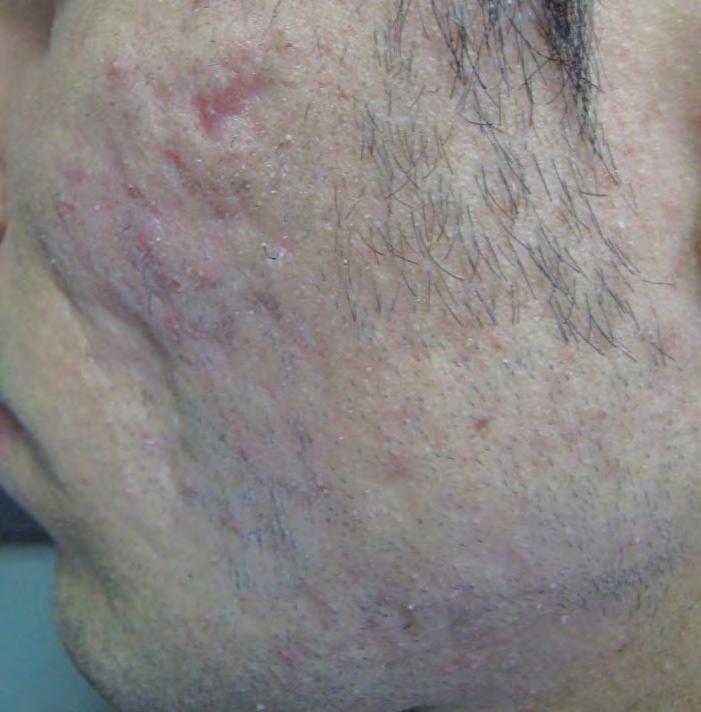 A Do Not B Figure 3. Left side of a patient s face before treatment with skin needling alone (A). Left side of the patient s face after treatment with skin needling alone (B).