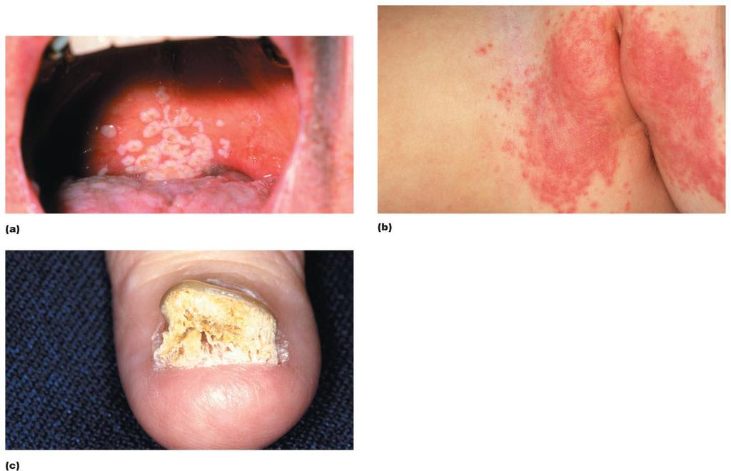 Candidiasis (Example of opportunistic systemic mycosis) Candida albicans is the most common causative agent Common microbiota of the skin and mucous membranes All cases of disease result from