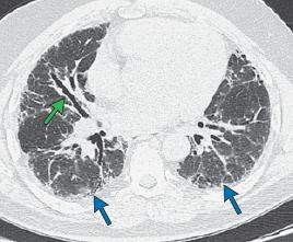 HRCT: allows detailed evaluation of the lung