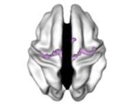 Prospective study of cortical thickness development in ADHD. Sampling of cortical thickness across 4 time points spaced on average 2.