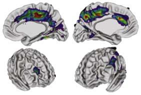 Prospective study of cortical thickness and ADHD persistence into adulthood.
