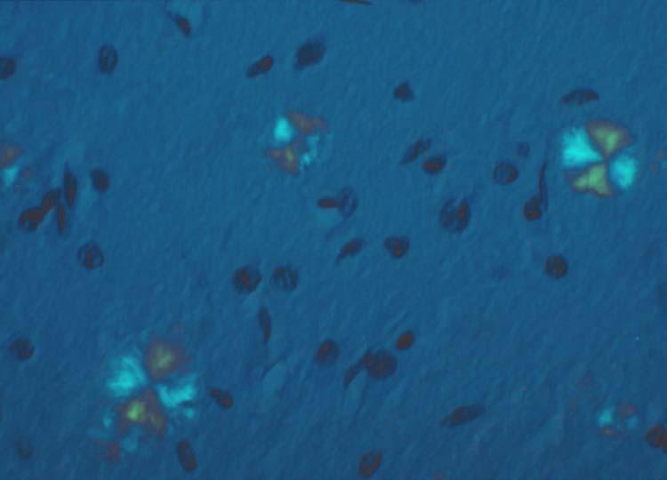 Birefringent amyloid plaques in a prion disease (GSS) Congo Red staining of Maltese-cross shaped