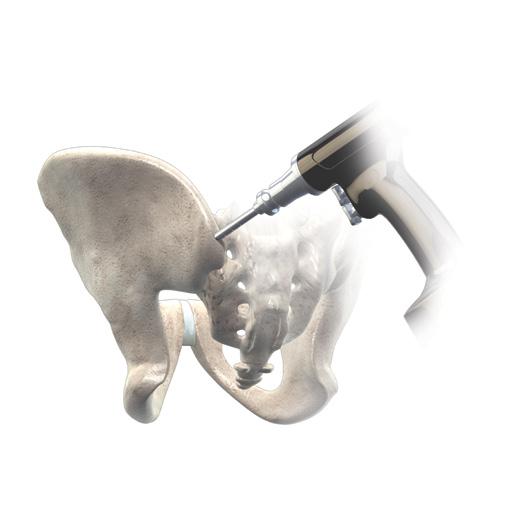 Posterior Ilium Crest Surgical Technique [continued] Figure 5 3 Harvest Autologous Bone