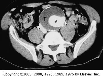 Figure 100-1 CT scan of abdominal aortic aneurysm shows contrast-filled lumen (*) surrounded by thrombus