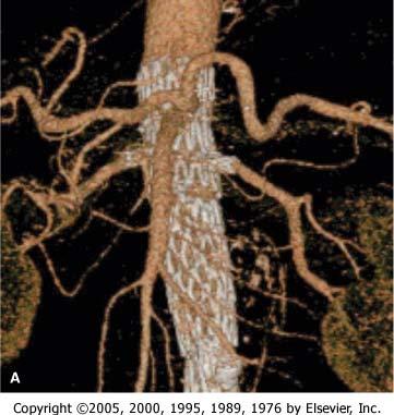 Figure 101-3 A, Three-dimensional reconstruction after fenestrated stent-graft with bare stents in the renal arteries. (Courtesy Dr. E. L. Verhoeven.