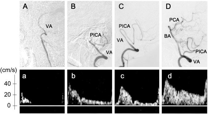 Saito et al Vertebral Artery Occlusion in Duplex Ultrasonography 1069 Figure 1.