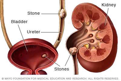 Often, stones form when the urine becomes concentrated, allowing minerals to crystallize and stick together.