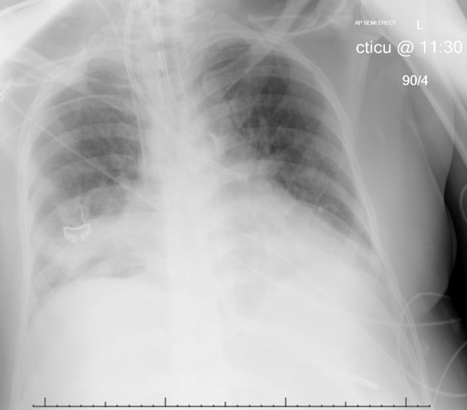 Case Study: SEQUENCE OF EVENTS 11:30 CXR Done 12:00 CXR reviewed on