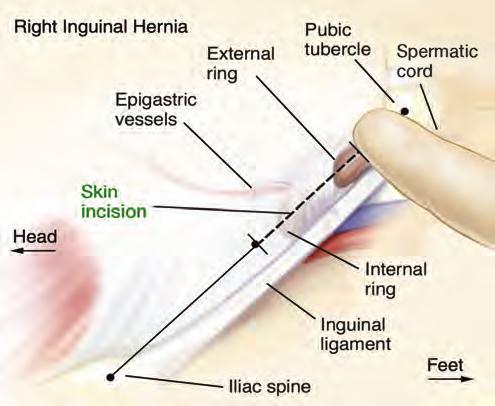 Technical Steps to the Procedure 1 Entry into the Inguinal Canal Mark the anterior superior iliac spine and the pubic tubercle.