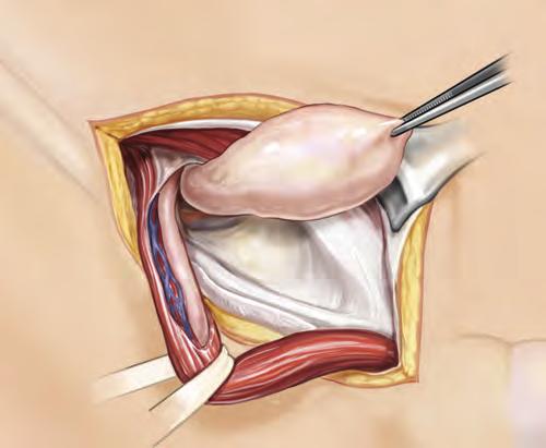Indirect Hernia (Peritoneum) 2 Dissect and Reduce the Hernia Sac Indirect Inguinal Hernia Repair Mobilize the spermatic cord and separate the cremasteric fibers.