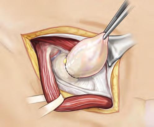 Direct Hernia (Transversalis Fascia) 3 Dissect and Reduce the Hernia Sac Direct Inguinal Hernia Repair Mobilize the spermatic cord and dissect the hernia sac