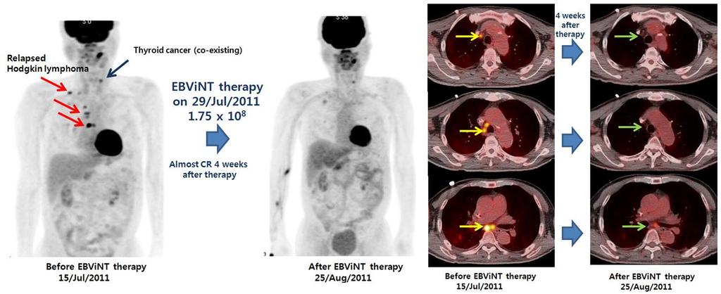 I-4. Cancer Immunotherapy at National Cancer Center EBViNT Cell Dose II (1/2 bag; 1.