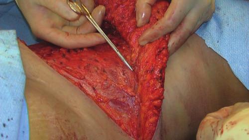 Antonetti and Antonetti 419 Figure 1. Progressive tension sutures are placed to include anterior abdominal fascia and Scarpa's fascia for strength. Figure 2.