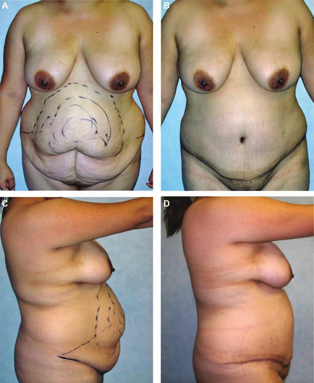 Antonetti and Antonetti 421 Figure 5. (A, C) This 29-year-old woman presented for treatment of her abdominal region.