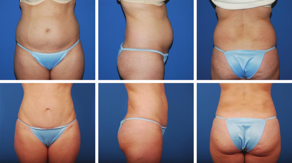Plastic and Reconstructive Surgery March 2013 Fig. 2. (Above) Photographs of a 41-year-old woman (G0P0) who underwent a modified abdominoplasty with liposuction of flanks.