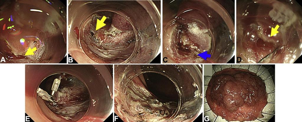 Endoscopic closure of post ESD colonic perforations 935 ESD (1998 2013) Perforation (5 mm ± 3mm) occurred in 25 cases (2.