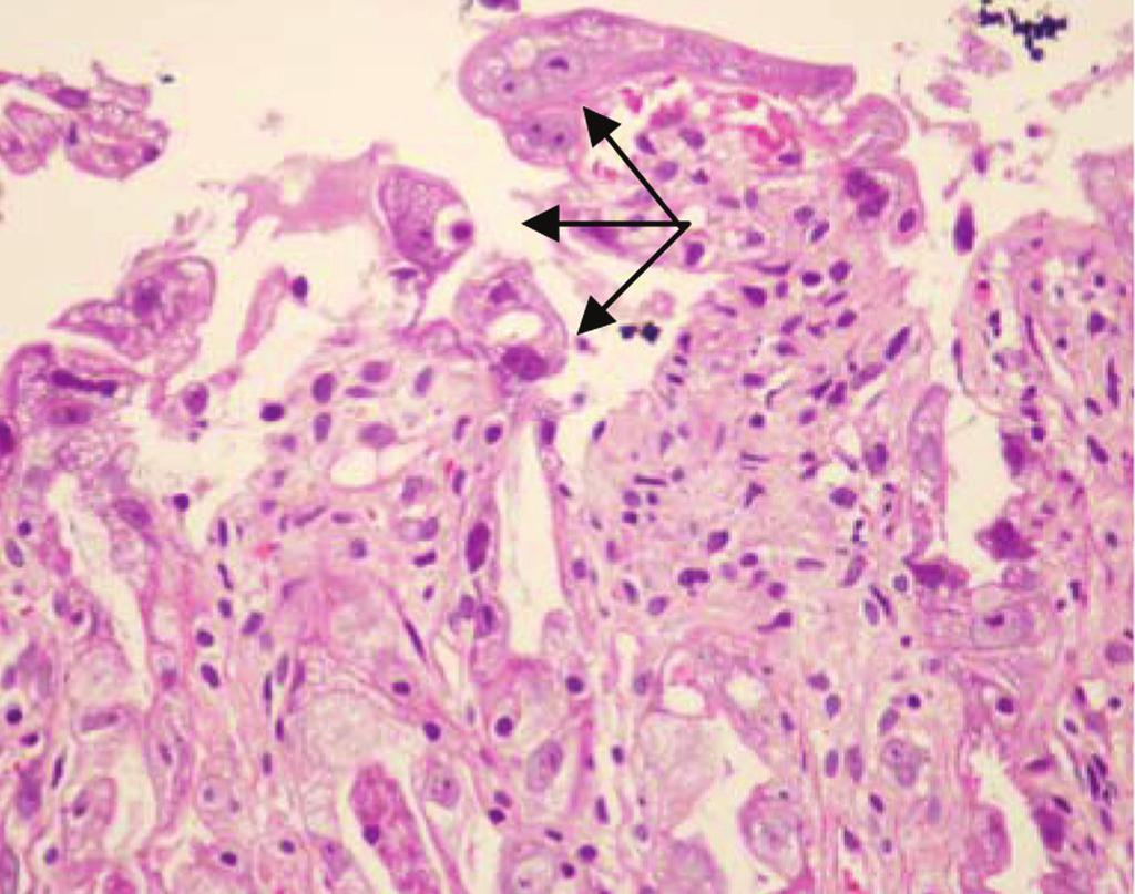 172 THAI J GASTROENTEROL 2010 Endoscopic Corner Figure 3. Diagnosis Poorly differentiated adenocarcinoma of the stomach causing linitis plastica.