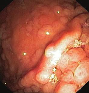 Fundic gland polyps (FGPs) are the most common gastric polyps in both familial adenomatous polyposis (FAP) and sporadic patients. FGPs are reported to occur in 12.