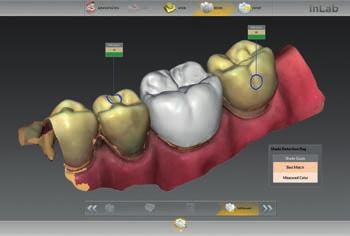 0: Tooth color display in inlab Software for digital impressions with CEREC Omnicam that were sent via Sirona Connect.