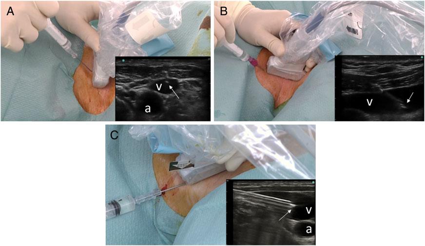 372 Batllori et al. Fig 1 Photographs of ultrasound transducer orientation and needle insertion with corresponding ultrasound images.