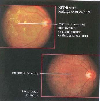 Laser surgery for Nonproliferative Diabetic Retinopathy (NPDR) In some cases of NPDR, blood vessels appear to be leaking everywhere in the macula a not just in a few specific areas.