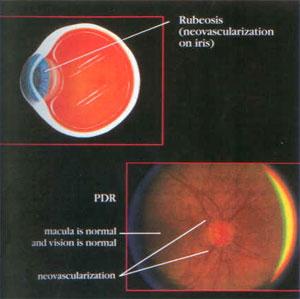 Proliferative Diabetic Retinopathy (PDR) A third problem that can occur is when neovascularization grows on the iris, the colored part of the eye, rather than just on the retina.