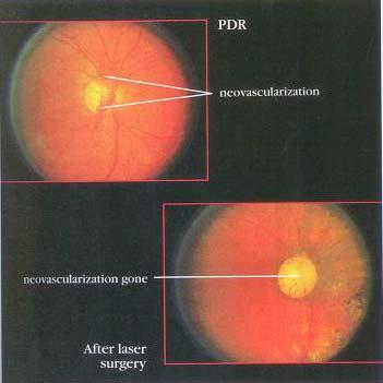 Laser Surgery for Proliferative Diabetic Retinopathy (PDR) All people with diabetes should be examined regularly to be sure that neovascularization is not developing.