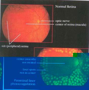 Laser Surgery for Proliferative Diabetic Retinopathy (PDR) Panretinal laser photocoagulation does not improve vision: it is the best possible means of holding vision stable to prevent further loss.