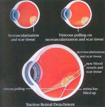 Traction Retinal Detachment DIABETIC RETINOPATHY In PDR, the neovascularization may cause scar tissue to develop.