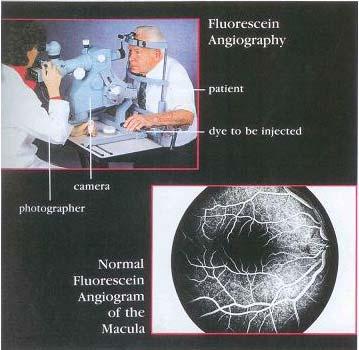 Fluorescein Angiography DIABETIC RETINOPATHY If your doctor diagnoses diabetic retinopathy and feels that laser surgery might be helpful, a special test called fluorescein angiography may be done.