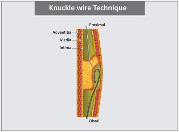 What is benefit of retrograde knuckle wire technique?