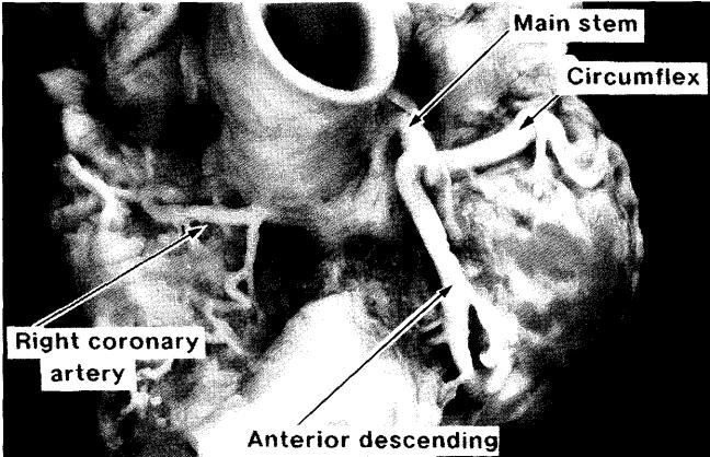 Anderson RH, Surgical anatomy of the heart.