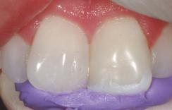 Filtek TM Introduction to Layering with Supreme Plus Universal Restorative A fast-setting bite registration material was used to impression the lingual surfaces and incisal edges of the right central