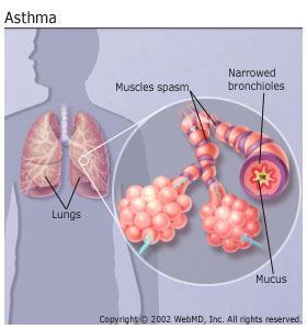 Asthma Narrowing of the air passages by the spasm contractions of the