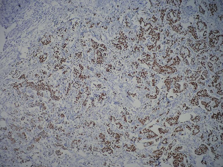 Cancer Biol Med Vol 11, No 2 June 2014 117 with micropapillary carcinoma.