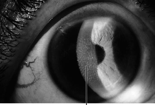 Reis- Buckler Corneal Dystrophy Abnormal deposition of collagen replacing Bowman s Gray lesions in honeycomb shape Autosomal dominant RCE s at young age