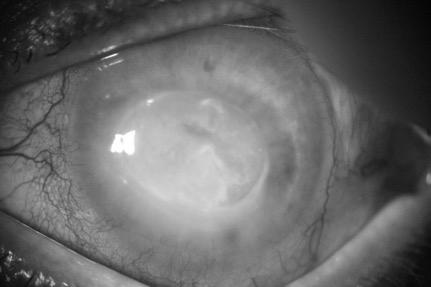 Endothelitis Area of corneal edema No epi involvment pseudo-