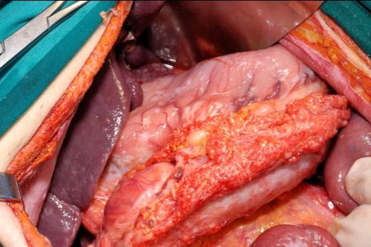 Peritonectomy Procedures and HIPEC for Peritoneal Metastasis from Ovarian Cancer http://dx.doi.org/10.5772/60844 93 by diffuse visceral and parietal PC [4].
