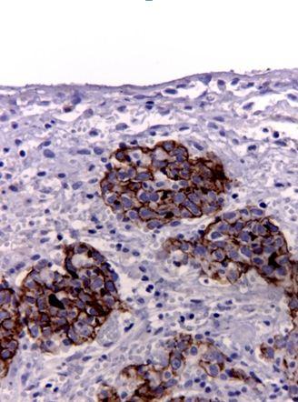 96 Gynecologic Cancers - Basic Sciences, Clinical and Therapeutic Perspectives Figure 2. Microfocus of neoplastic cells inside fibrous desmoplastic tissue- CA-125 immunohistochemistry. second-look.
