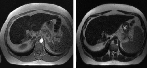 Review: iron overload Figure 4 Magnetic resonance imaging of the liver in iron overload. T1-weighted out of phase sequence (left) consistent with focal fatty infiltration.