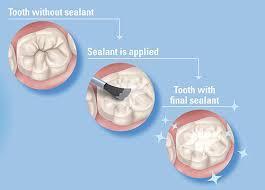 Two dental metrics encourage focused attention on the application of dental sealants