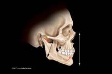 A systematic approach to full-mouth reconstruction of the severely worn dentition Jay Lerner demonstrates a procedure that allows the clinician to obtain the space required for the restoration of
