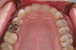 revealed the second molars to be in premature contact when the condyles were seated in centric relation Figure 7: An intraoral composite mockup was performed to establish the ideal length