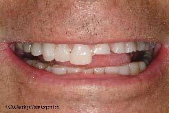 This anterior separation may provide enough space for the clinician to restore the aesthetic requirements of tooth length while maintaining a position that allows restoration of maximum