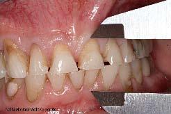 The following case presentation demonstrates a means to obtain the space required for the restoration of severely worn dentition without altering the VDO.