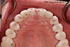 Due to the advanced wear of the remaining teeth, the treatment plan involved full-coverage restorations on all teeth.