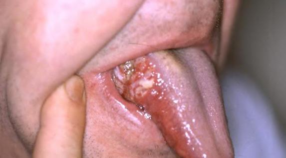 Oral Cancer Oral cancer appears as a growth or sore in the mouth that does not go away.